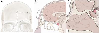 Individualized surgical treatment of giant tuberculum sellae meningioma: Unilateral subfrontal approach vs. endoscopic transsphenoidal approach